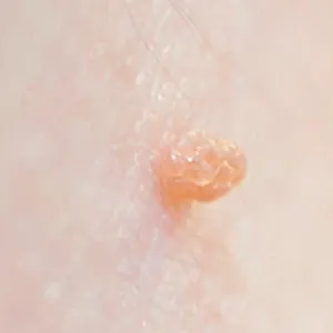 Cryotherapy in Kent