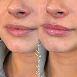 lip and dermal filler treatment